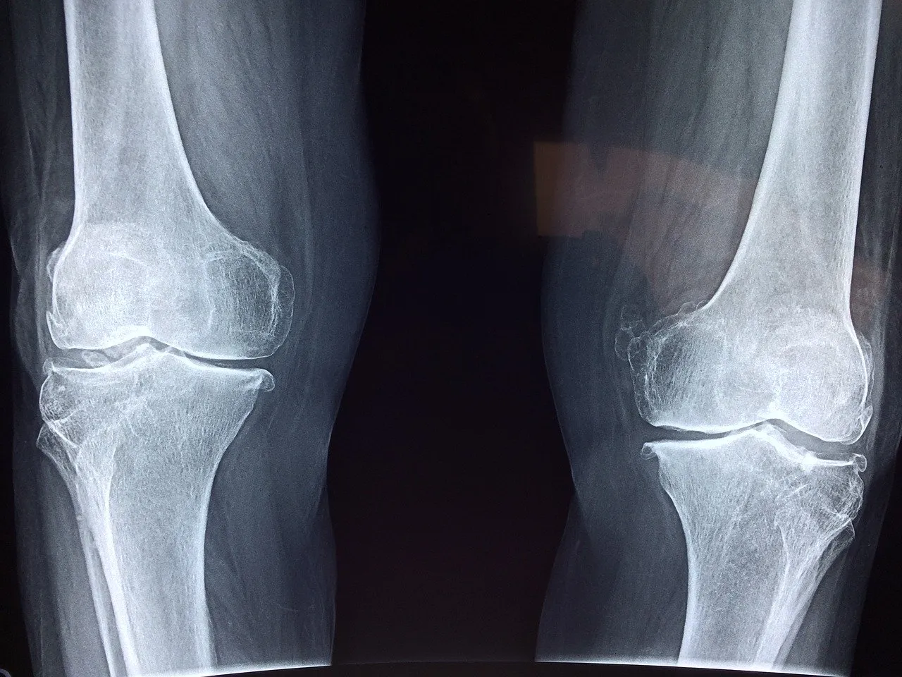 reconstruction ligament anterieur